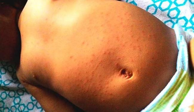 Conheça a história por trás da descoberta do zica em Camaçari