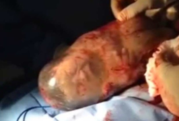 Bebê nasce ainda dentro da bolsa amniótica (Foto: Reprodução)