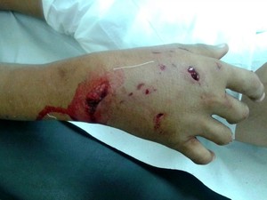 Menino teve mão mordida (Foto: Arquivo Pessoal)