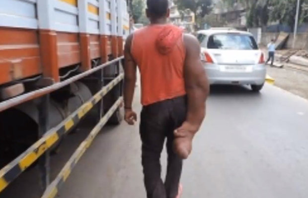 Indiano de 25 anos sofre com gigantismo localizado; braço chega a pesar 20 kg