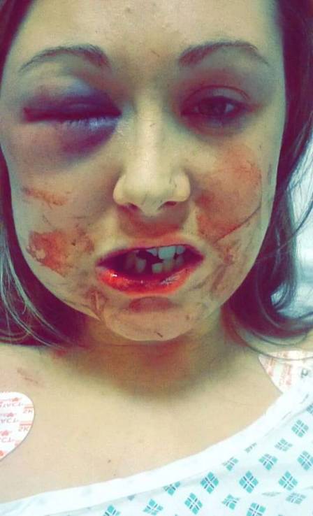 Ela precisou ser hospitalizada e quebrou três dentes, a mandíbula e chegou a ficar inconsciente (Foto: Reprodução/Facebook)