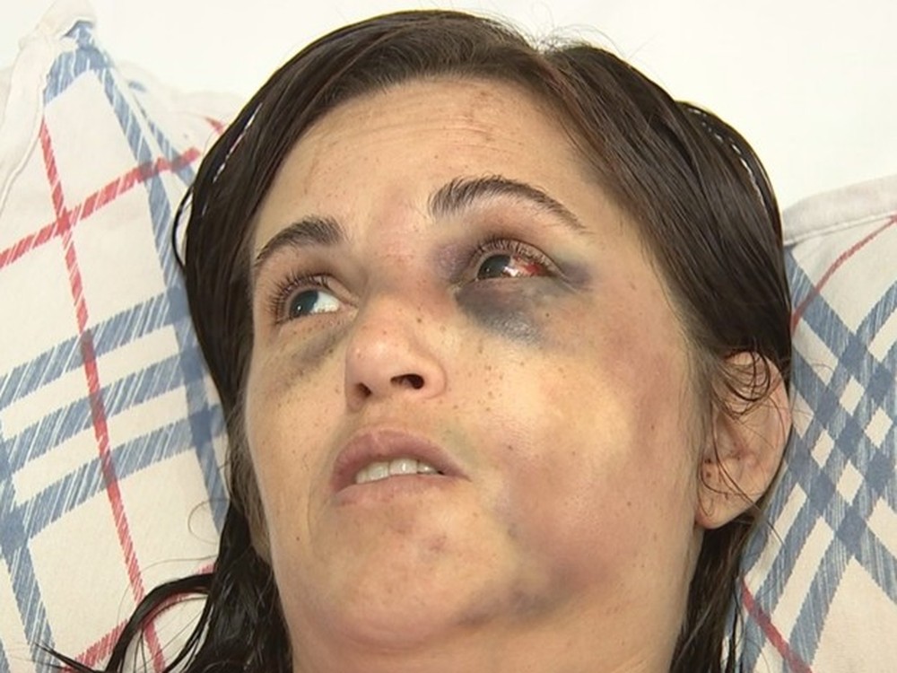 Sandra Almeida apanhou do marido e ficou com traumas no rosto (Foto: Reprodução/TV TEM)