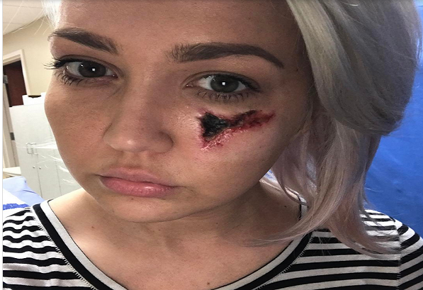 Por volta do nono dia, o tecido facial ao redor da picada começou a ficar preto, um sinal de necrose (quando o tecido morre) Por volta do nono dia, o tecido facial ao redor da picada começou a ficar preto, um sinal de necrose (quando o tecido morre)