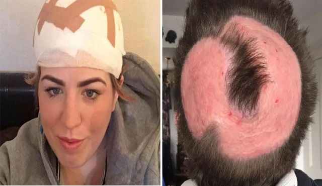 Inglesa passou por diversas cirurgias para recuperar couro cabeludo (Foto: Reprodução | Facebook)