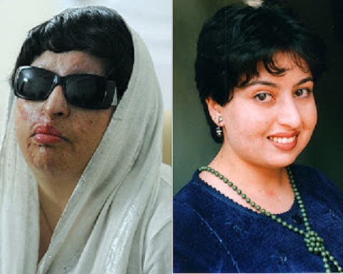 A iraniana Ameneh Bahrami, de 34 anos, ficou desfigurada depois que um colega de faculdade com quem ela se recusou a casar atirou ácido em seu rosto