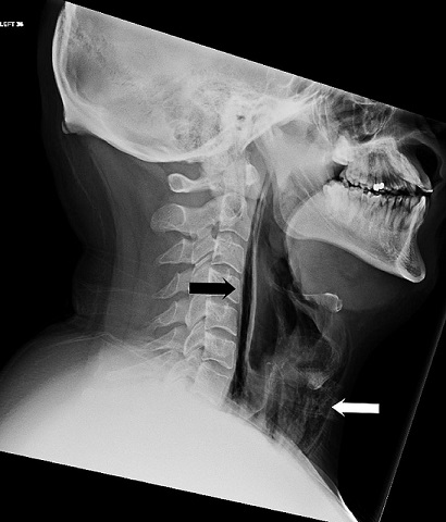 Paciente teve que ser internado por sete dias para se recuperar da fratura (Foto: BMJ Case Reports)
