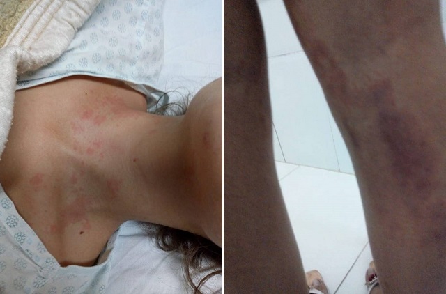 Moradora de Camaçari em tratamento contra Esporotricose depois de contrair o fungo (Foto: Montagem | Redação CFF)