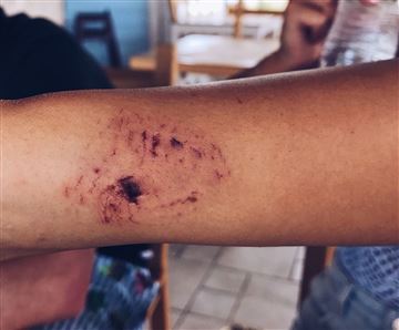  Apesar do susto, ela passa bem, ficando apenas com uma cicatriz ao redor do braço, que segundo os médicos que a atenderam, nunca mais sumirá de sua pele.
