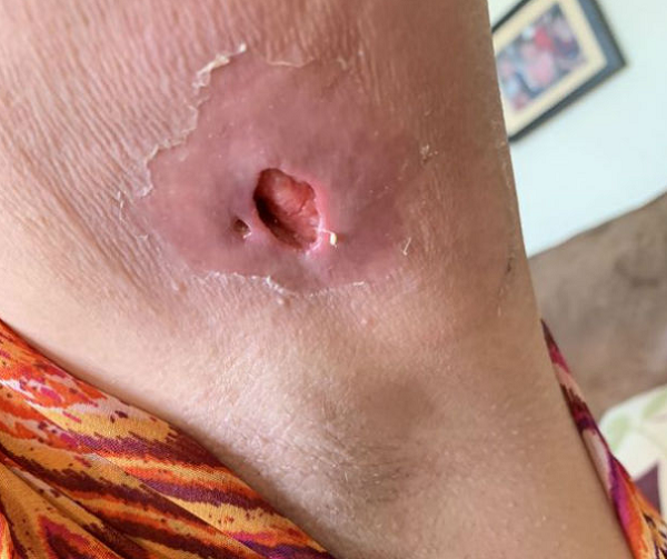 Abscesso removido tinha o tamanho de uma bola de golfe (Foto: Reprodução)