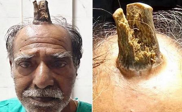 O chifre, que era formado por queratina (proteína encontrada também em unhas e cabelo), foi retirado em hospital de Sagar (Índia) (Foto: Reprodução)
