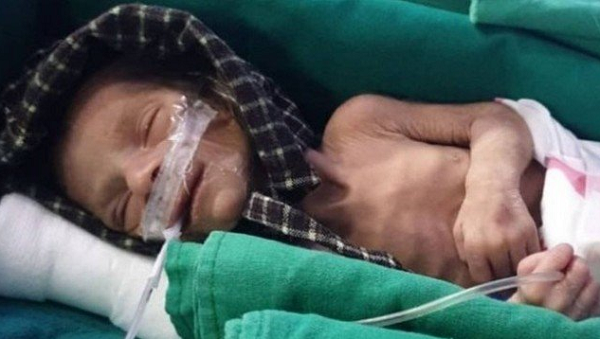 A menina foi resgatada por um morador que sepultava a própria filha, morta após o nascimento (Foto: Reprodução)