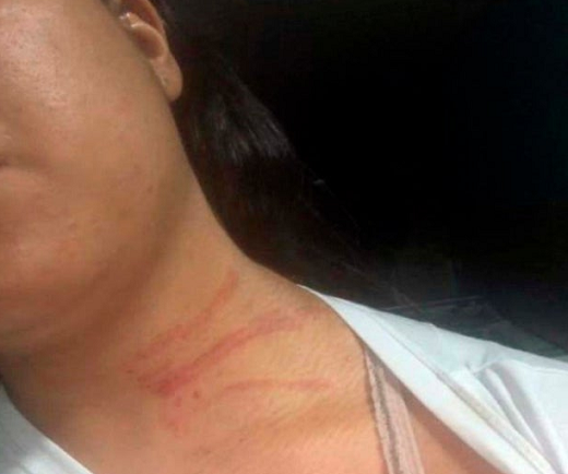 Mylena Santos Andrade mostra marcas da agressão sofrida pelo ex (Foto: Divulgação | Polícia Civil)