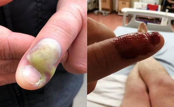 homem contraiu uma infecção mortal roendo unha (Foto: Reprodução)