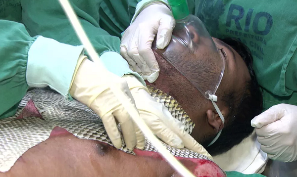 Paciente em tratamento com pele de tilápia (Foto: Reprodução | TV Globo)