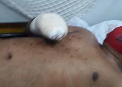 Homem teve mão direita amputada (Foto: Reprodução)