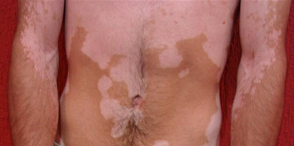 Uma das poucas vezes que Gildásio se deixou ser fotografado por causa do preconceito contra o vitiligo (Foto: Reprodução/Acervo pessoal)