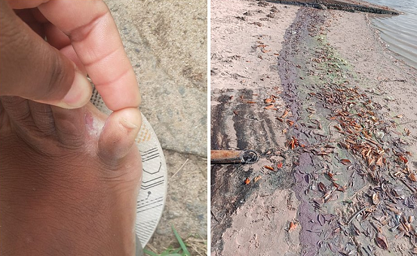 Pescadora e Marisqueira, Cleidiane Portugal sofreu queimaduras entre os dedos dos pés (Foto: Acervo pessoal/Reprodução)