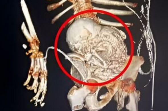 Após a morte da idosa, a família autorizou os estudos de bebê que se calcificou há mais de 50 anos (Foto: Reprodução)