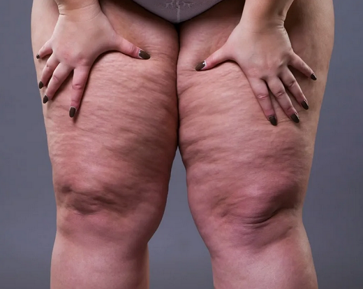 Lipedema é uma condição caracterizada pelo acúmulo anormal de gordura, geralmente nas pernas e nas coxas (Foto: Divulgação)