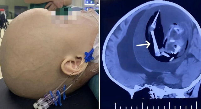 A menina não resistiu à cirurgia e faleceu 12 dias após o procedimento (Foto: Reprodução)