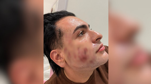 Jovem desejava aliviar as marcas de acne no rosto (Foto: Reprodução)
