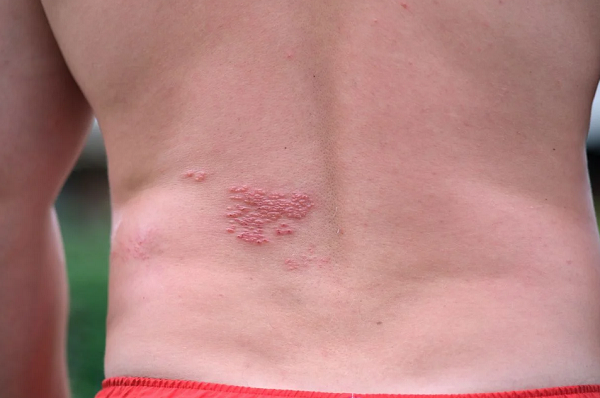Herpes-Zóster (Foto: Shutterstock)