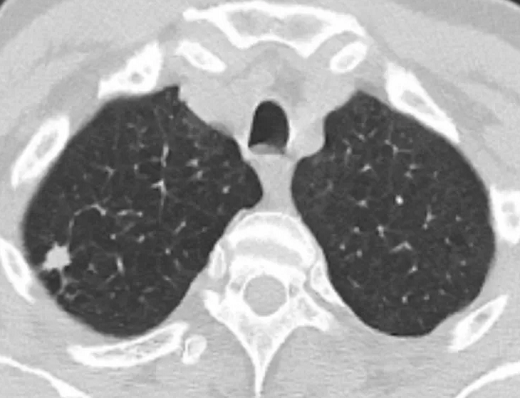 Imagem com características morfológicas de câncer de pulmão (Foto: Arquivo A TARDE)
