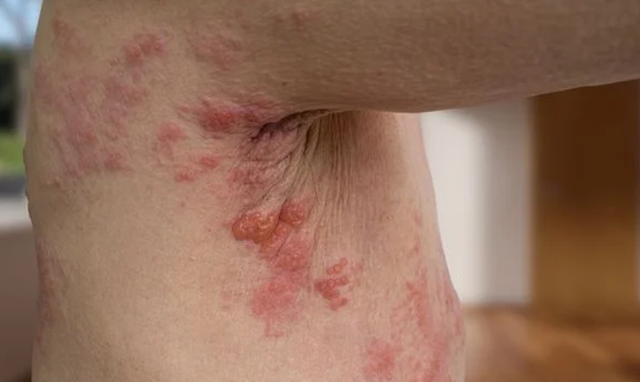 Internações por herpes zoster aumentam; saiba como se prevenir (Foto: Shutterstock)