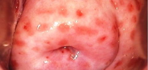 A Cervicite tem entre as causas mais comuns, as Infecções Sexualmente Transmissíveis, principalmente clamídia e gonorreia - Foto: Divulgação/Internet