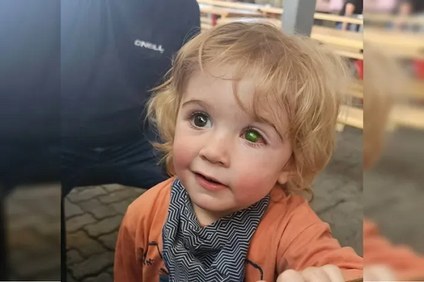 O menino acabou desenvolvendo uma ferida aberta na córnea (Foto: Reprodução/Redes sociais)