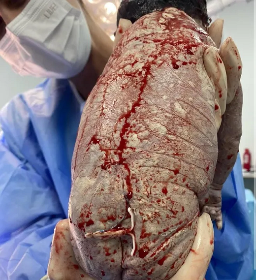 A médica Rafela Frota, que realizou o parto registrou o momento nas redes sociais (Foto: Reprodução/@drarafaelafrota)