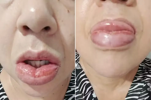 Ardência, inchaço, aftas, dores e irritações na boca são algumas das reações (Foto: Reprodução/Redes Sociais)