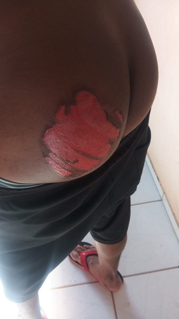 BÁRBAROS – Homem com deficiência é queimado com ferro quente na Bahia; suspeitos são presos