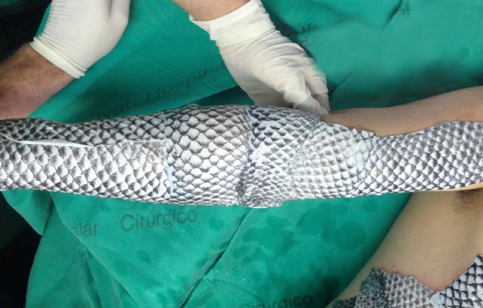 curativo-de-tilapia-entenda-como-pele-de-peixe-est0140285000202609211116