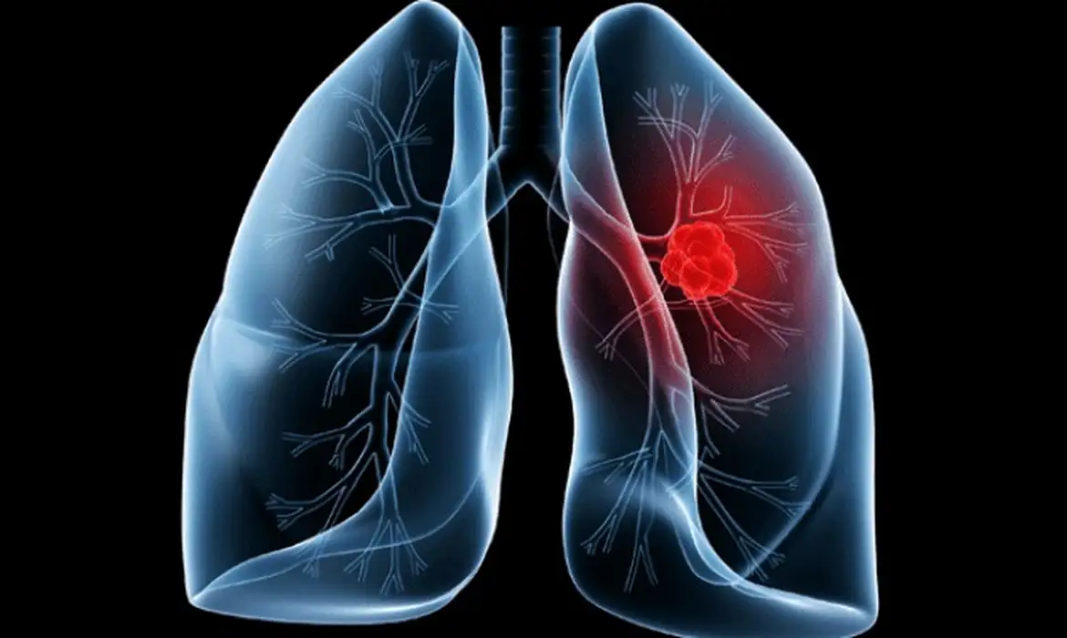 cancer-de-pulmao