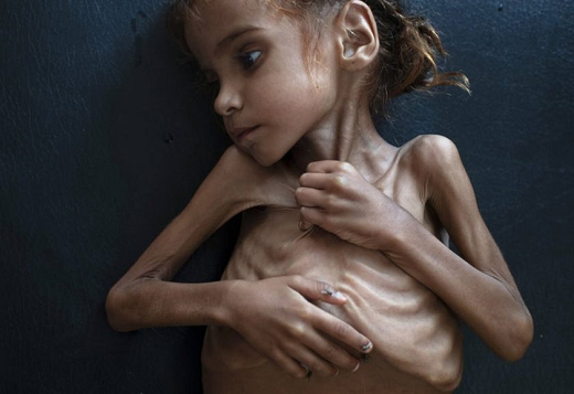 Amal Hussain, uma garota de 7 anos cuja imagem deitada em uma cama de hospital no norte do Iêmen se tornou o símbolo da fome no país (Foto: Tyler Hicks | The New York Times)