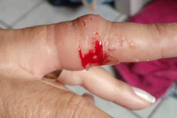 Vítima sofreu ferimentos no dedo após ação do criminoso (Foto: Reprodução)