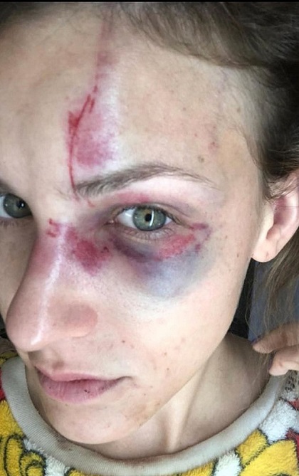 Melissa conta que recebeu chutes no rosto e teve a cara arrastada no chão, sendo puxadas pelos cabelos (Foto: Reprodução) Melissa conta que recebeu chutes no rosto e teve a cara arrastada no chão, sendo puxadas pelos cabelos (Foto: Reprodução)