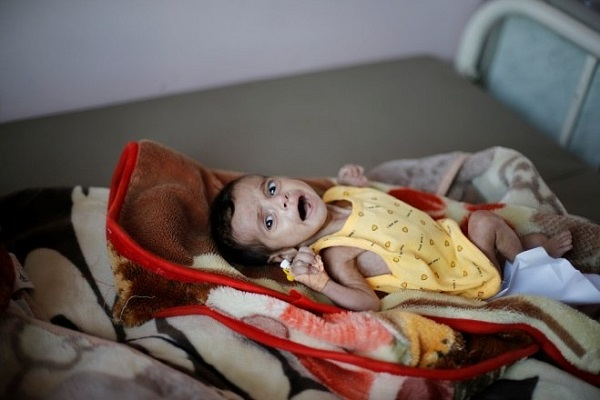 Uma em cada vinte crianças menores de cinco anos sofre de desnutrição aguda severa (Foto: Reprodução) Uma em cada vinte crianças menores de cinco anos sofre de desnutrição aguda severa (Foto: Reprodução)