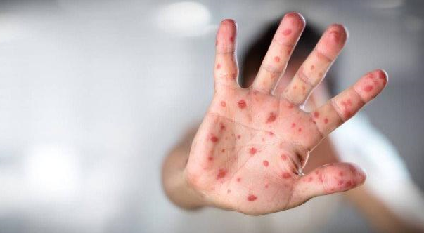 A secretaria determinou que os municípios notifiquem imediatamente qualquer caso suspeito da doença em pacientes que apresentarem os sintomas (Foto: Reprodução) A secretaria determinou que os municípios notifiquem imediatamente qualquer caso suspeito da doença em pacientes que apresentarem os sintomas (Foto: Reprodução)