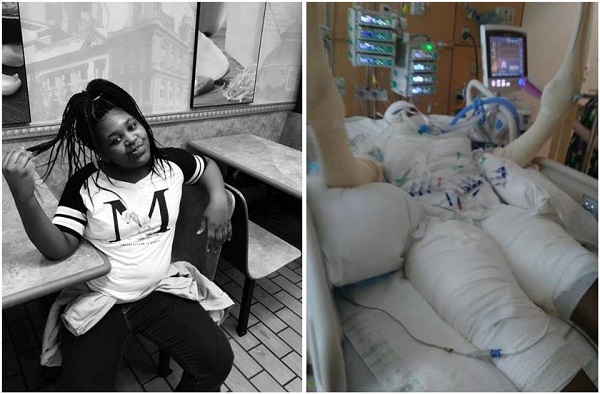 Timiyah Landers está com quase metade do corpo marcado por queimaduras de segundo e terceiro grau (Foto: Reprodução) Timiyah Landers está com quase metade do corpo marcado por queimaduras de segundo e terceiro grau (Foto: Reprodução)