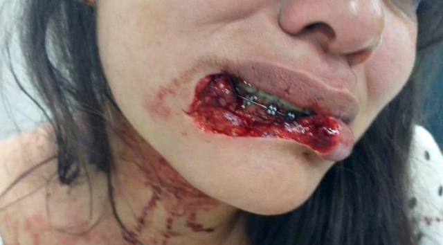 Vítima que perdeu de 70% a 80% do lábio inferior passou por microcirurgia reparadora (Foto: Reprodução)