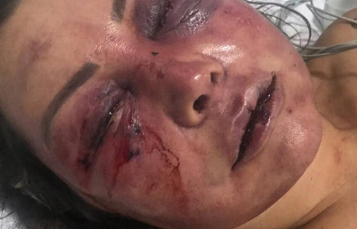 Elaine levou quase 40 pontos dentro da boca. Também sofreu fratura no nariz e nos ossos da órbita (região próxima aos olhos) (Foto: Reprodução) 