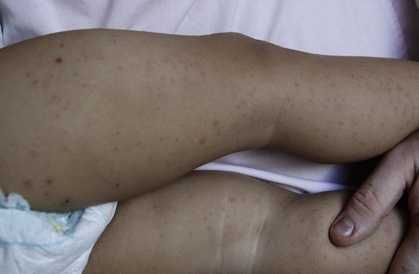 Infectado, bebê está com manchas pelas pernas (Foto: Almiro Lopes | CORREIO) 