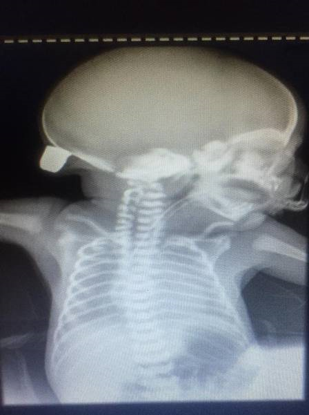 A radiografia do bebê mostra a bala alojada na cabeça (Foto: Reprodução)