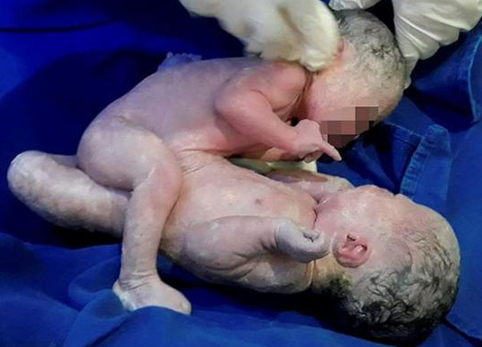 Unidas pelo abdômen, elas dividem fígado, rim, bexiga e órgão reprodutor (Foto: Reprodução)